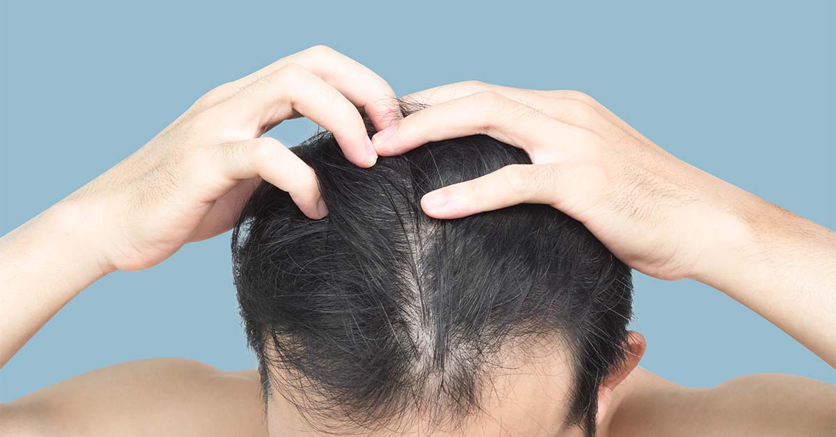 Man checking scalp and hair loss