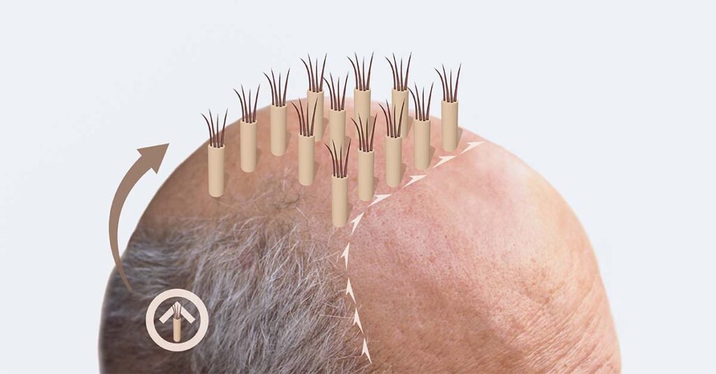 Illustrated hair follicle extraction and transplantation