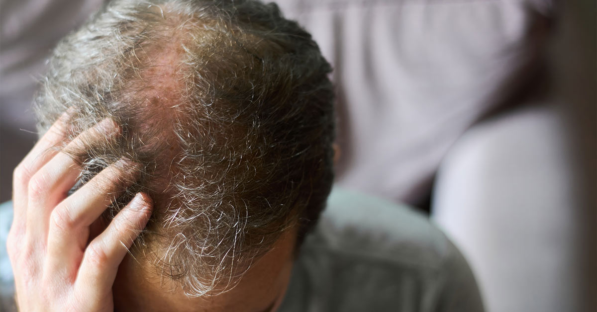 Man with balding on his crown.