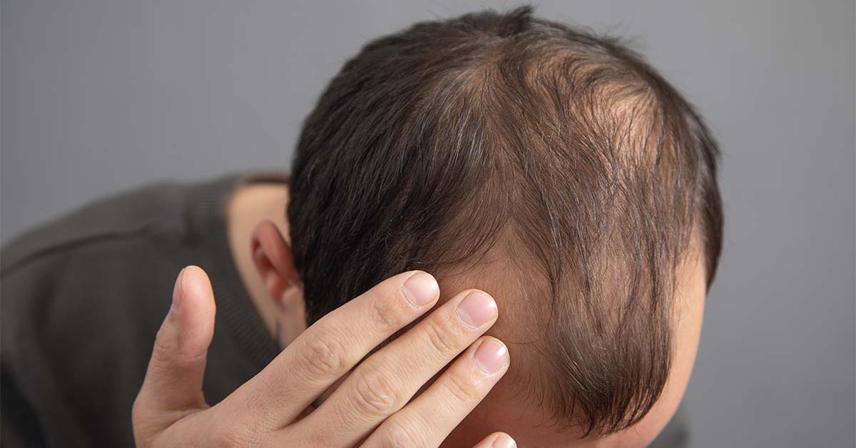 Man touching receding hairline.