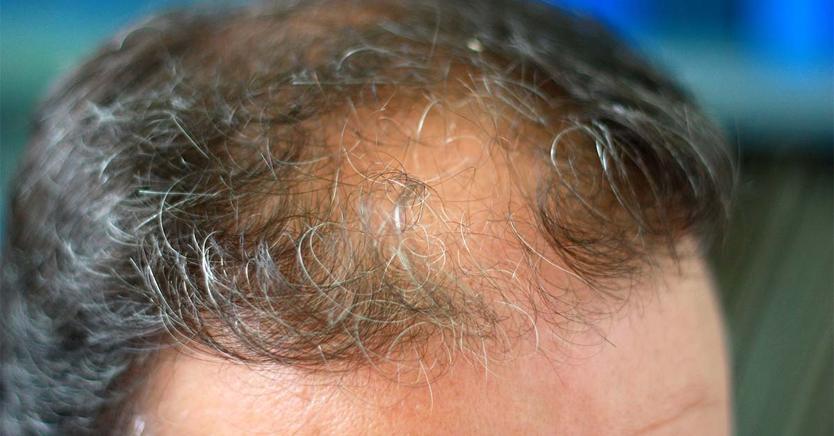 Balding patches on the head