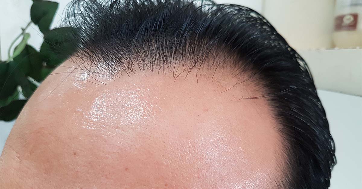 Sweating hairline
