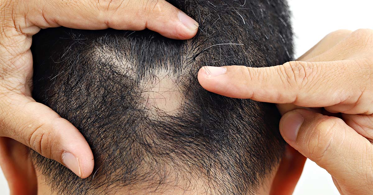 Balding patch on head