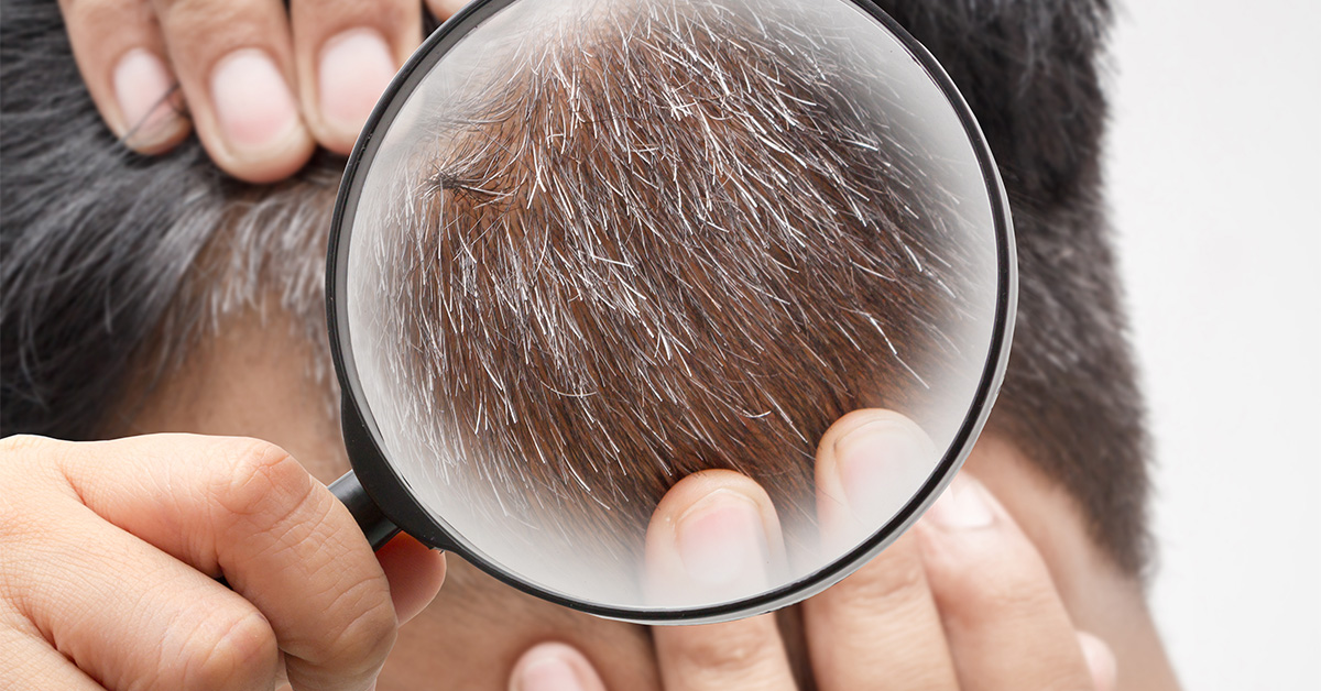 Magnifying glass over scalp hair.