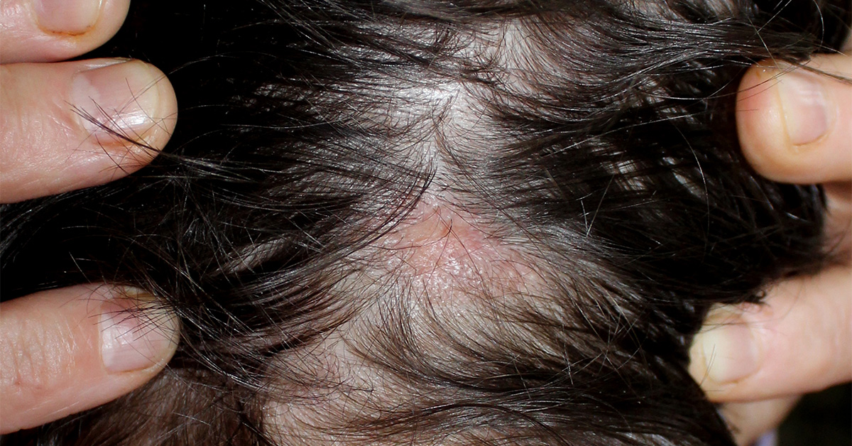 Man with a rash or sore under his hair.