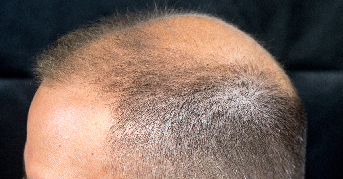 Balding crown