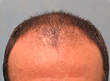 Close-up of a person's scalp