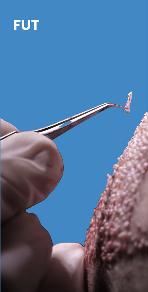 FUT hair transplant surgery results