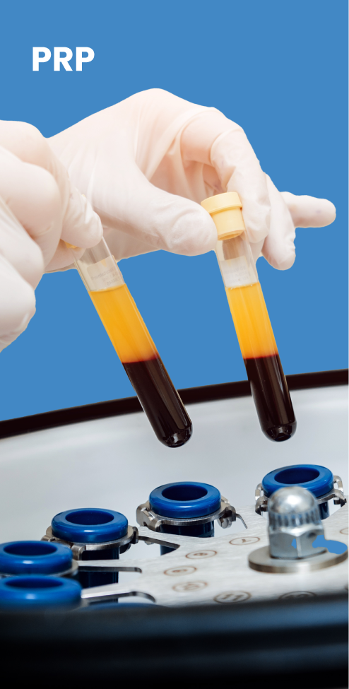 PRP therapy for hair loss