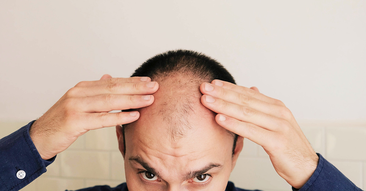Male pattern baldness