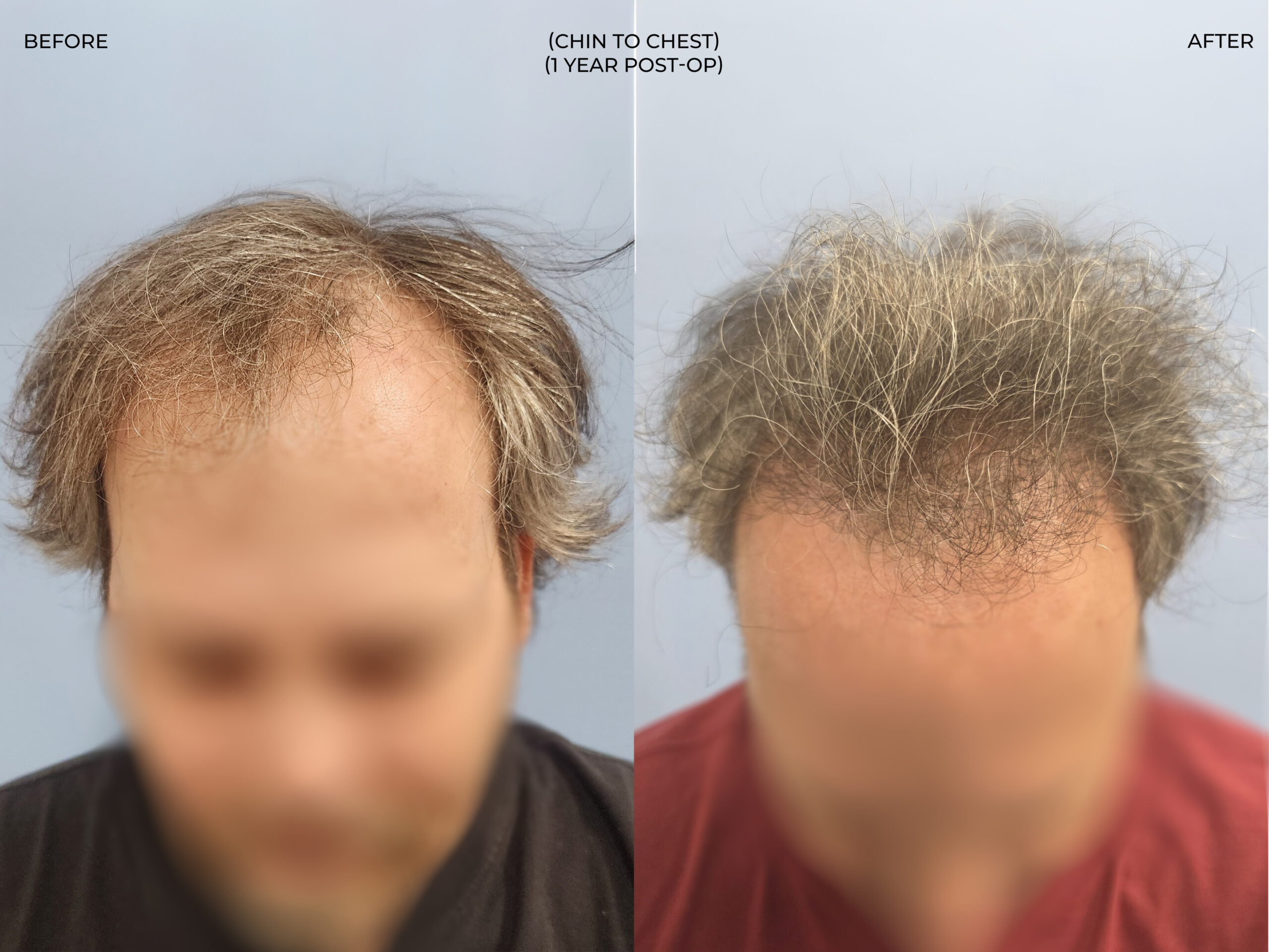 Chin to chest view before and after FUT (strip), 3,381 grafts, 53 year old man