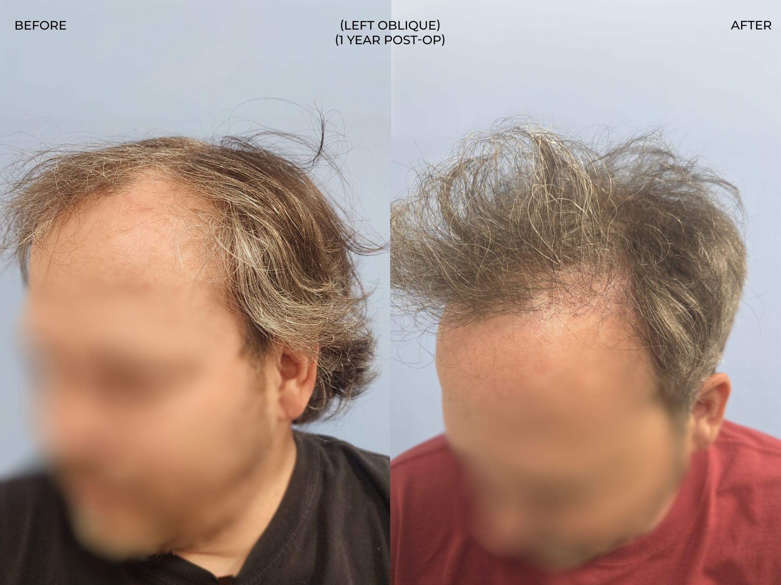 Left oblique view before and after FUT (strip), 3,381 grafts, 53 year old man