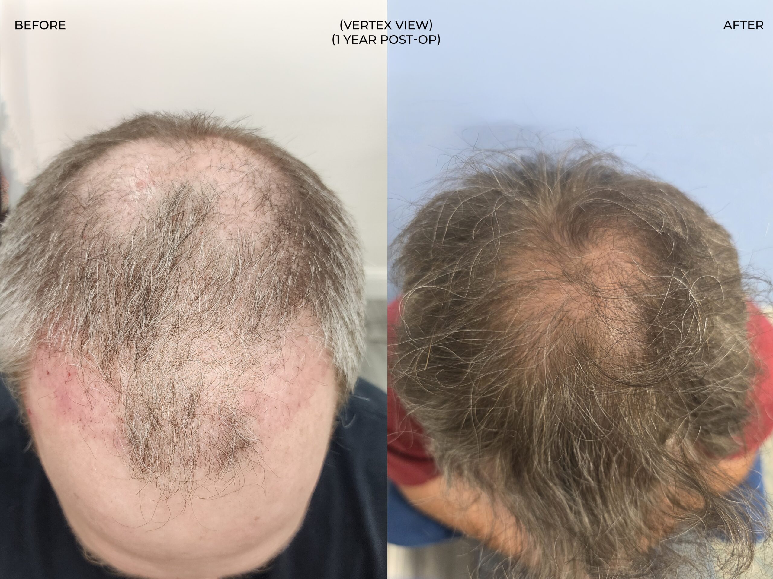 Vertex (crown) view before and after FUT (strip), 3,381 grafts, 53 year old man