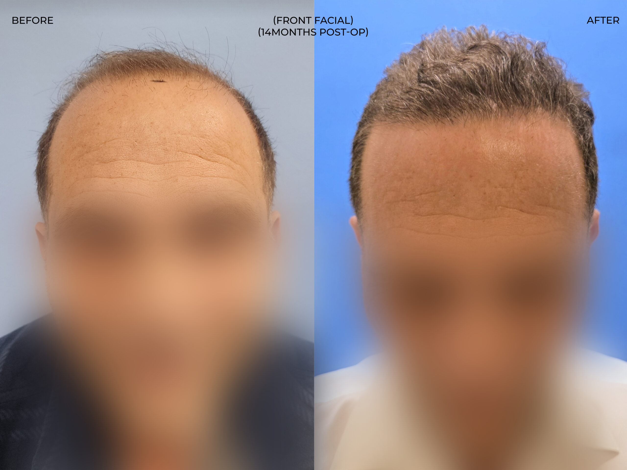Front facial view before and after FUE — ARTAS iXi robot + NeoGraft, 4,142 grafts, 59 year old man