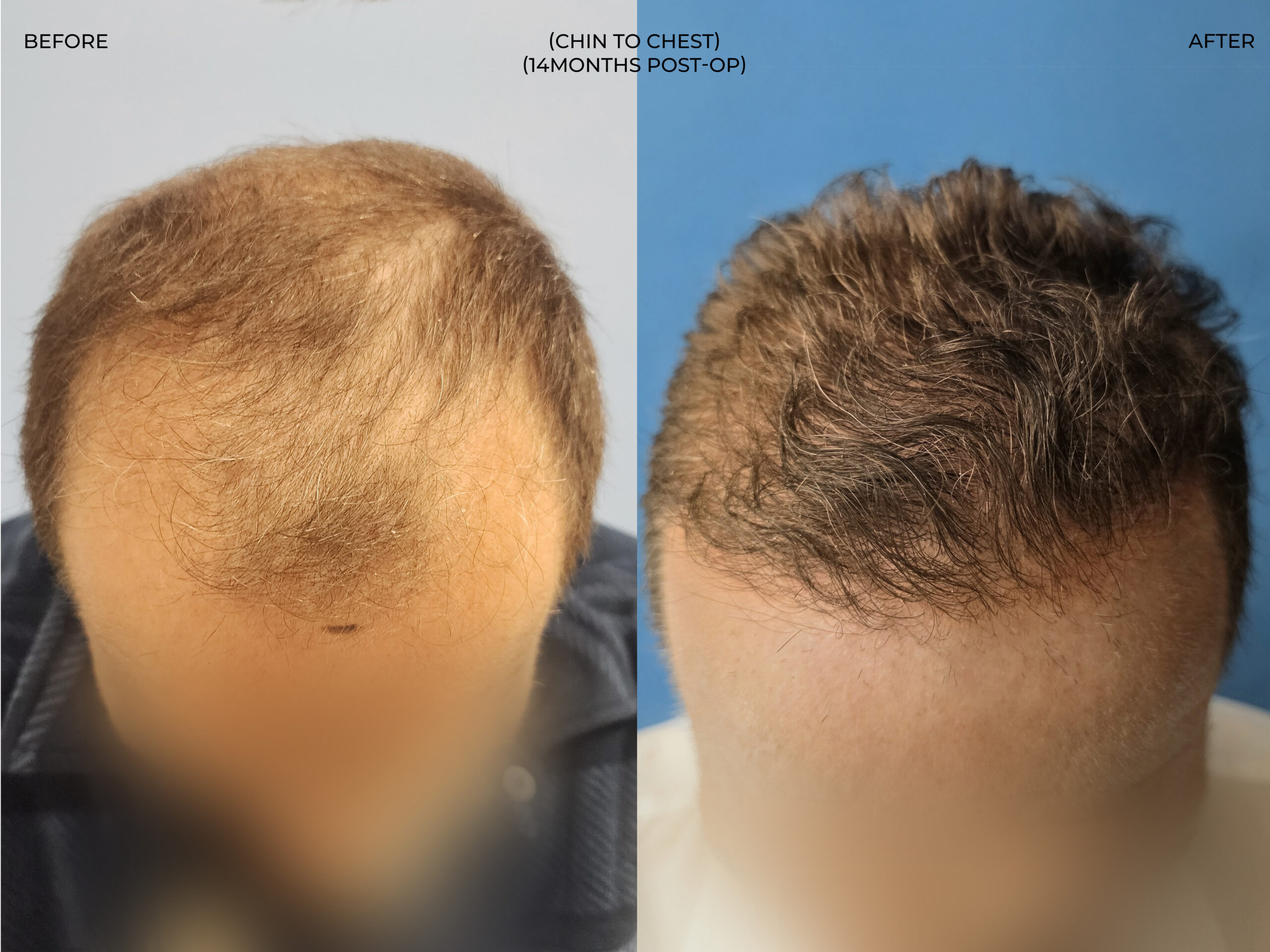 Chin to chest view before and after FUE — ARTAS iXi robot + NeoGraft, 4,142 grafts, 59 year old man