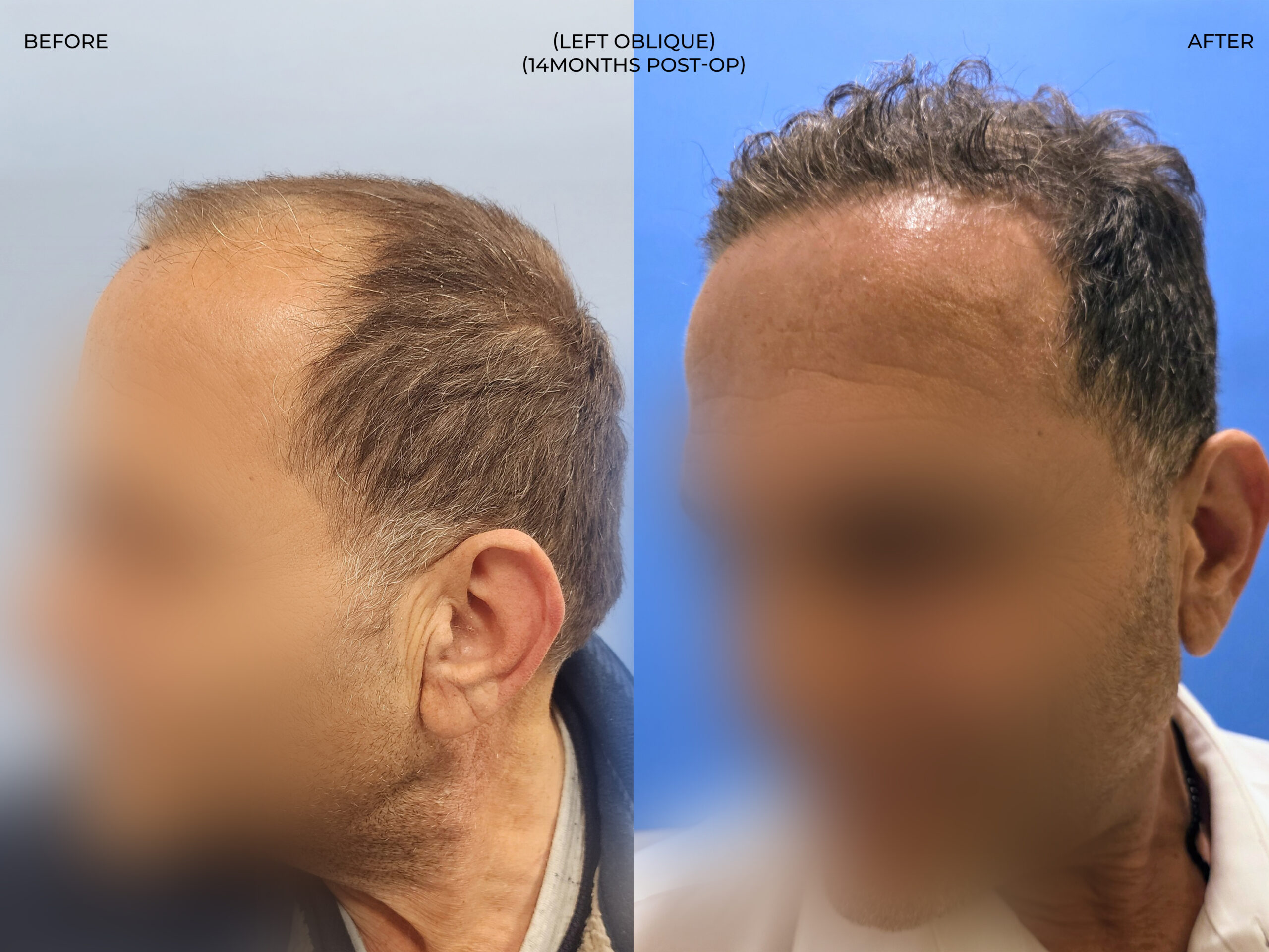 Left oblique view before and after FUE — ARTAS iXi robot + NeoGraft, 4,142 grafts, 59 year old man