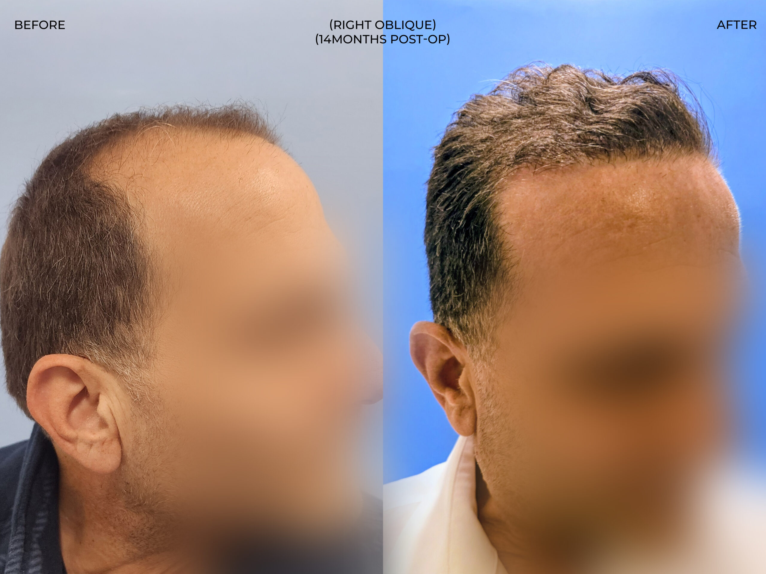 Right oblique view before and after FUE — ARTAS iXi robot + NeoGraft, 4,142 grafts, 59 year old man