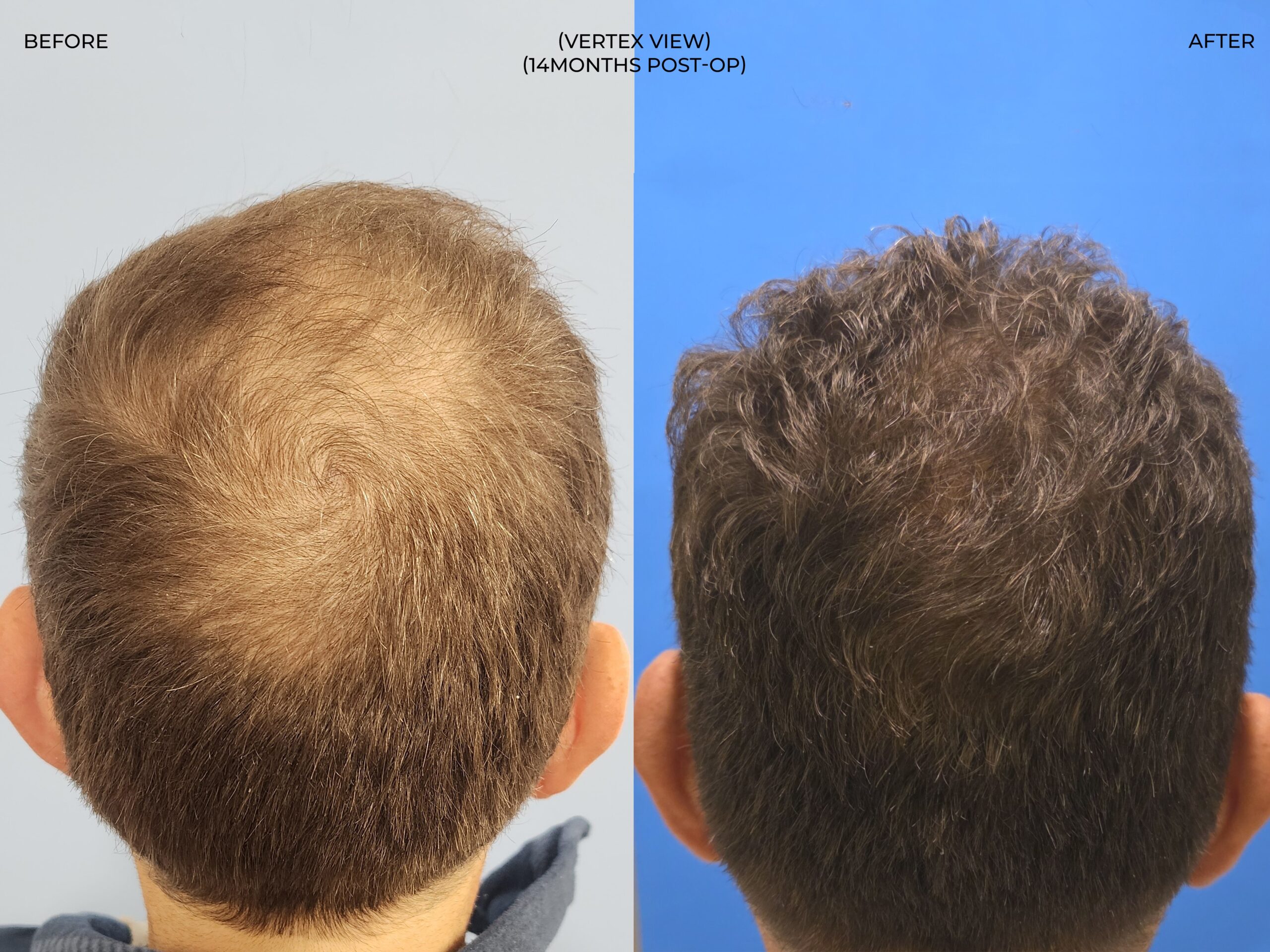 Vertex (crown) view before and after FUE — ARTAS iXi robot + NeoGraft, 4,142 grafts, 59 year old man