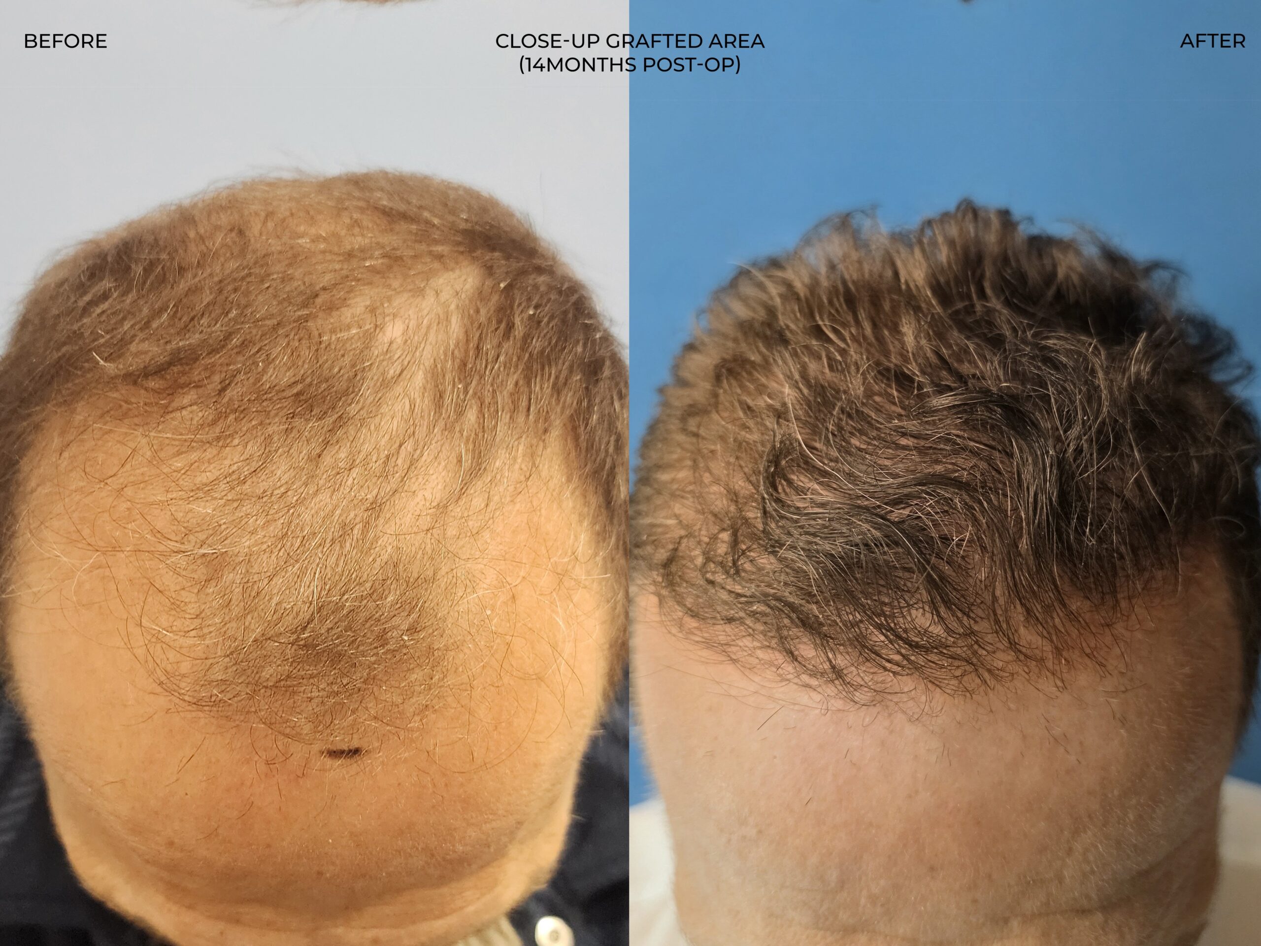 Top-down view before and after FUE — ARTAS iXi robot + NeoGraft, 4,142 grafts, 59 year old man