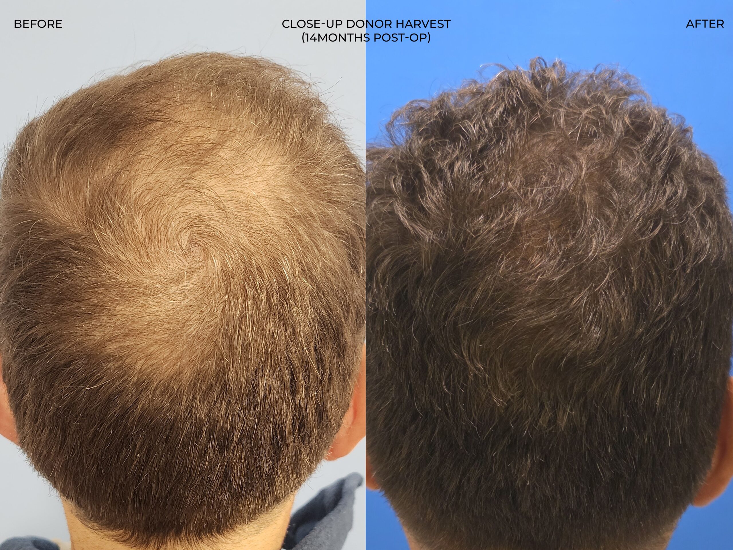 Donor area view before and after FUE — ARTAS iXi robot + NeoGraft, 4,142 grafts, 59 year old man