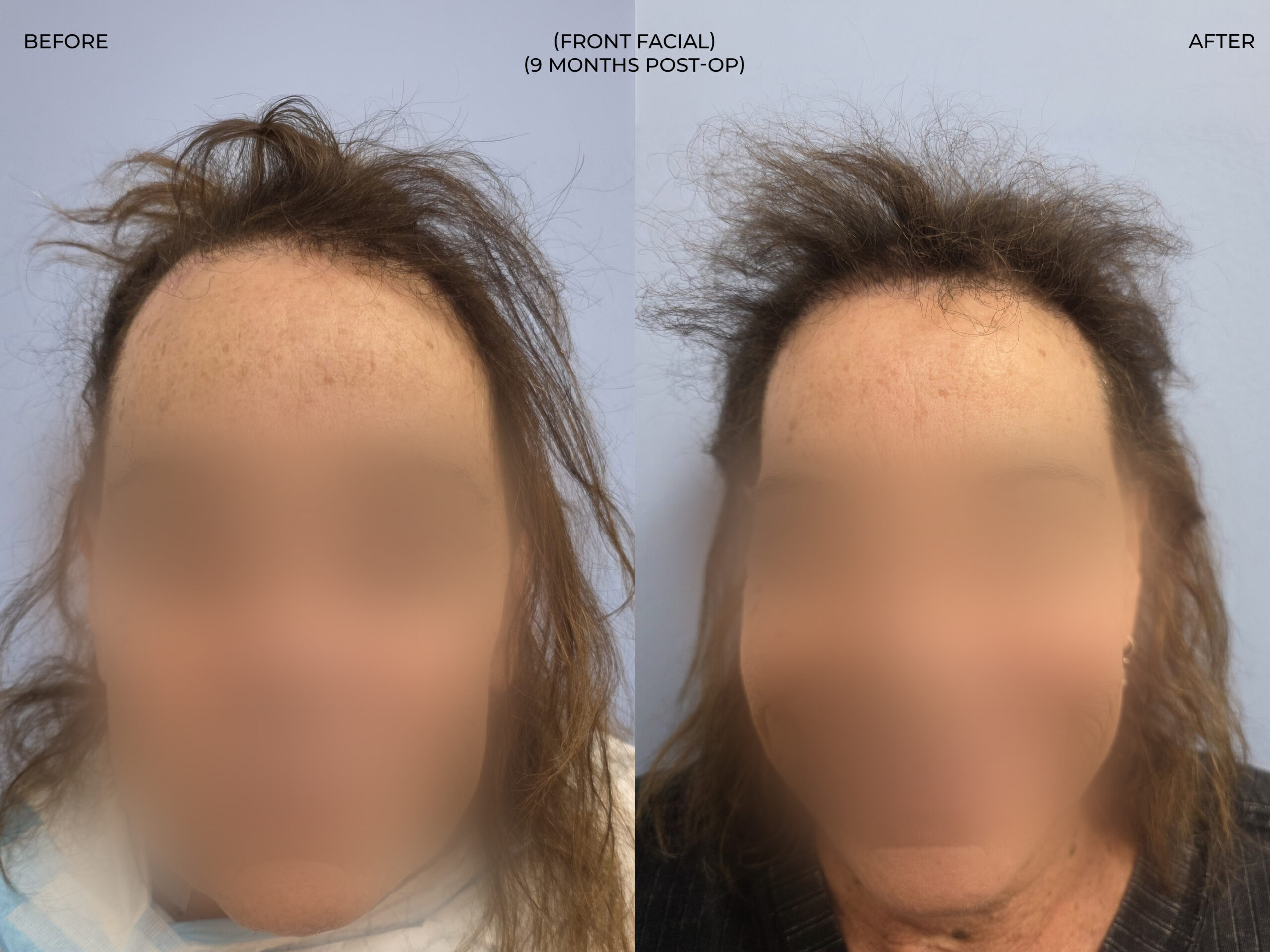 Front facial view before and after FUT (strip), 3,510 grafts, 73 year old woman
