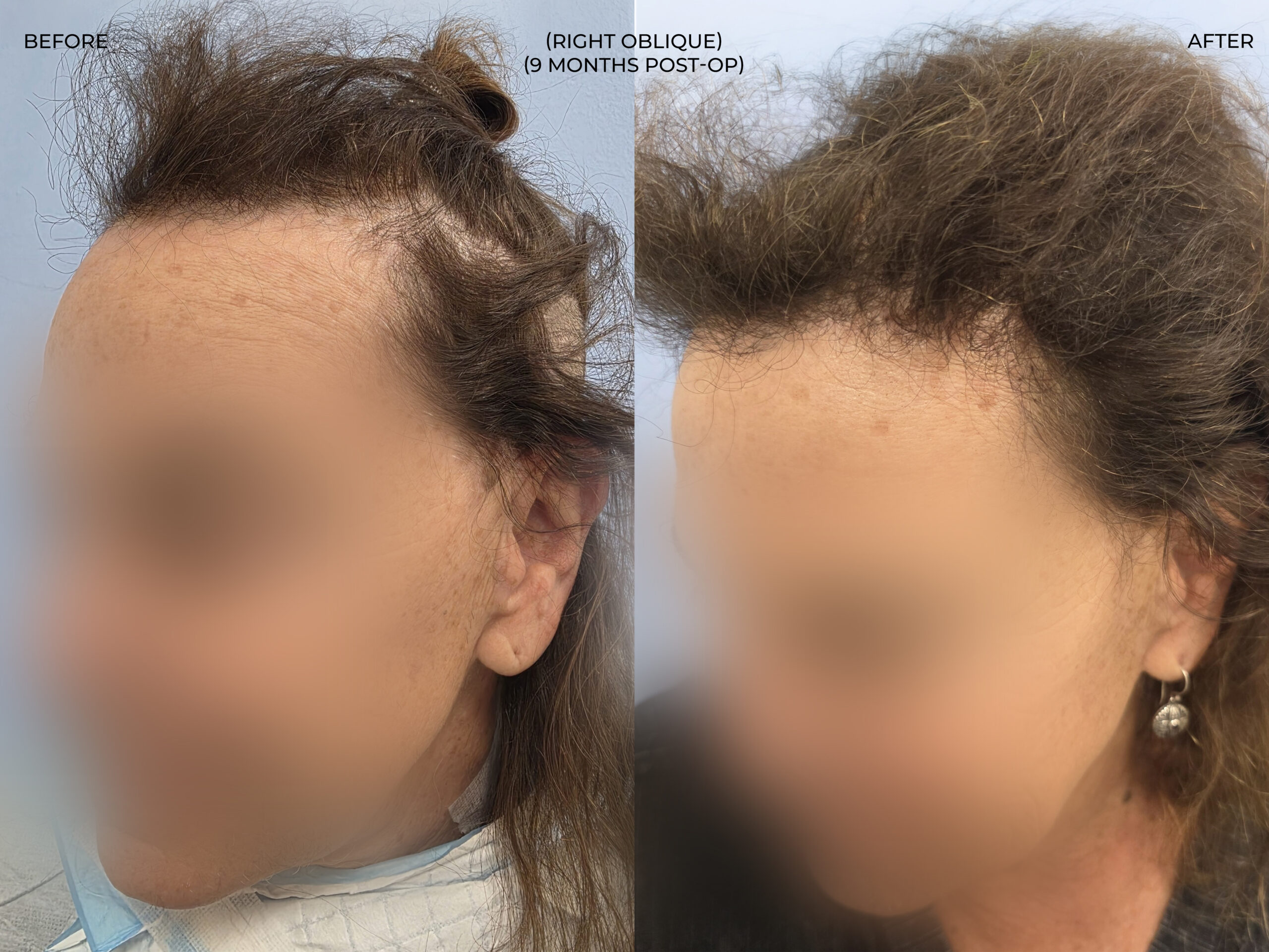 Right oblique view before and after FUT (strip), 3,510 grafts, 73 year old woman
