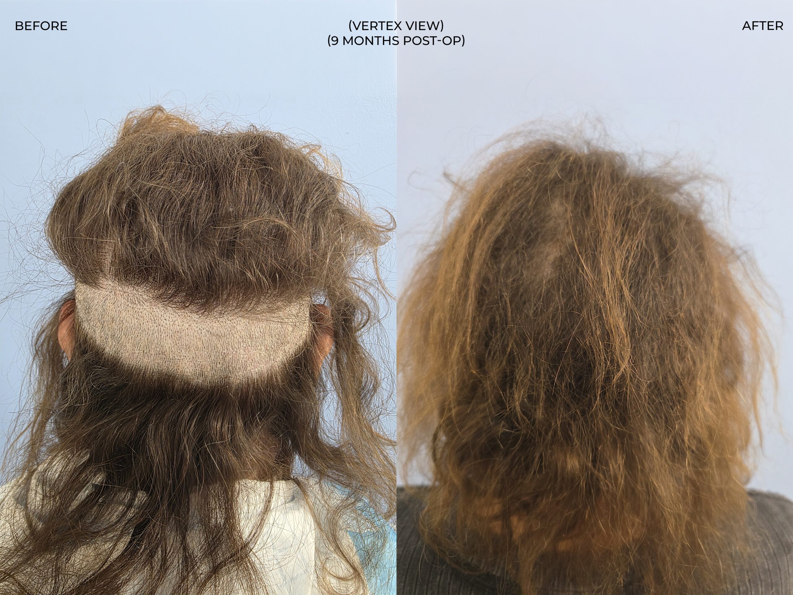 Vertex (crown) view before and after FUT (strip), 3,510 grafts, 73 year old woman