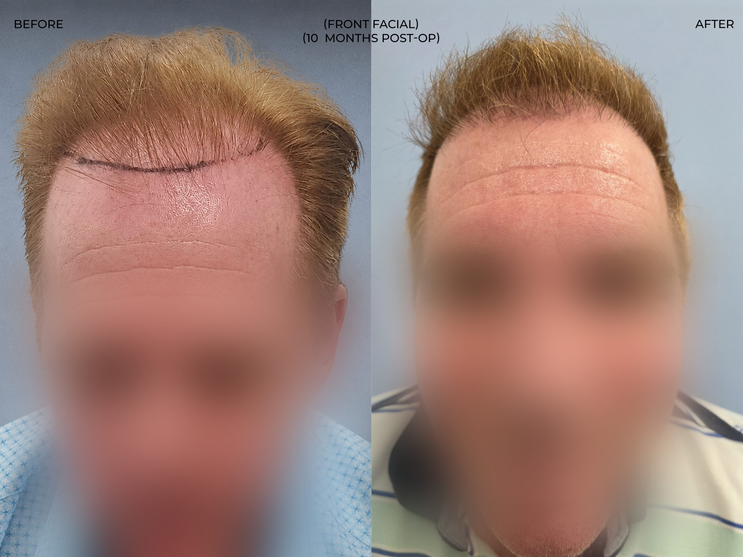 Front facial view before and after FUT (strip), 3,300 grafts, 57 year old man