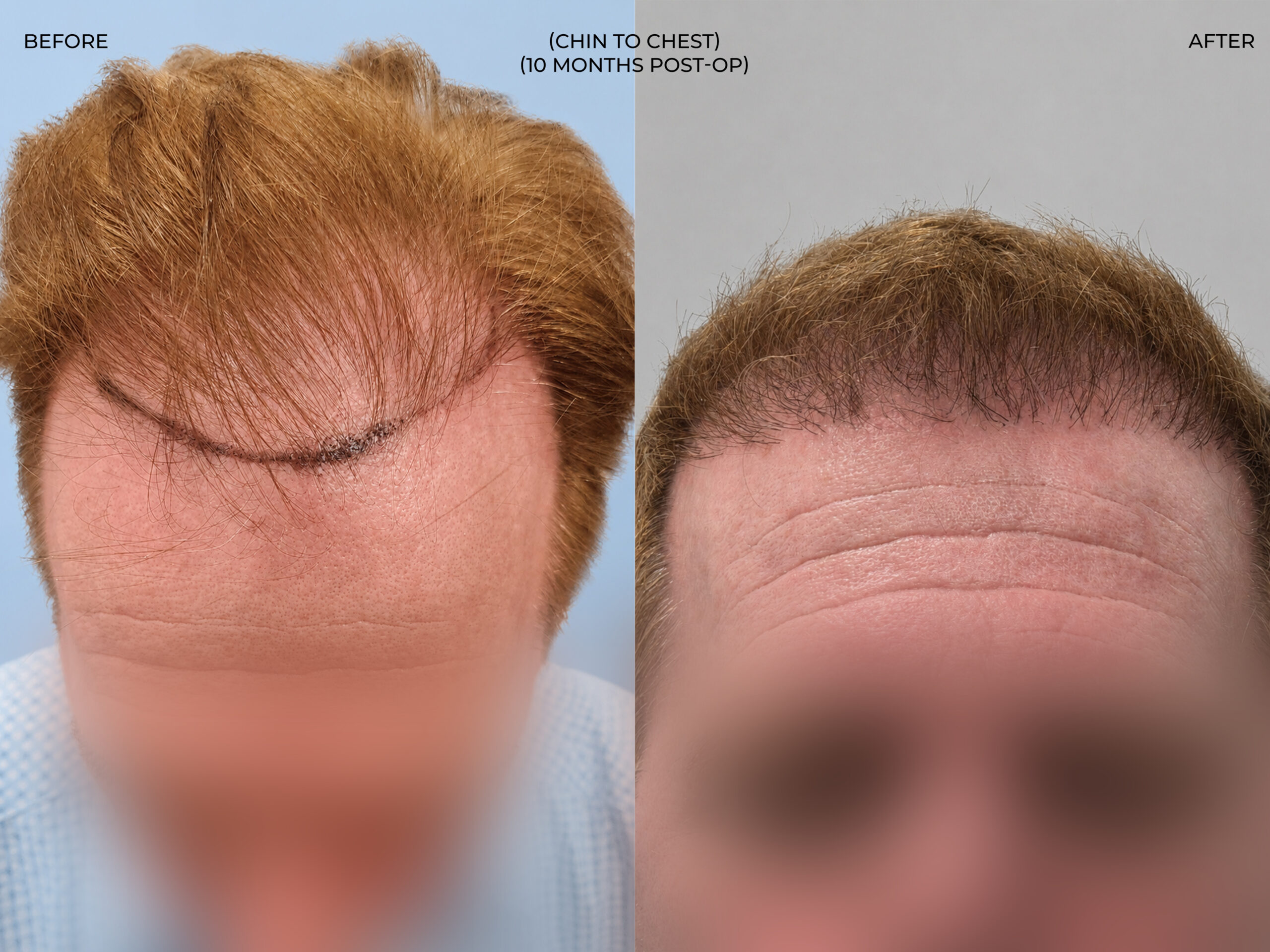 Chin to chest view before and after FUT (strip), 3,300 grafts, 57 year old man