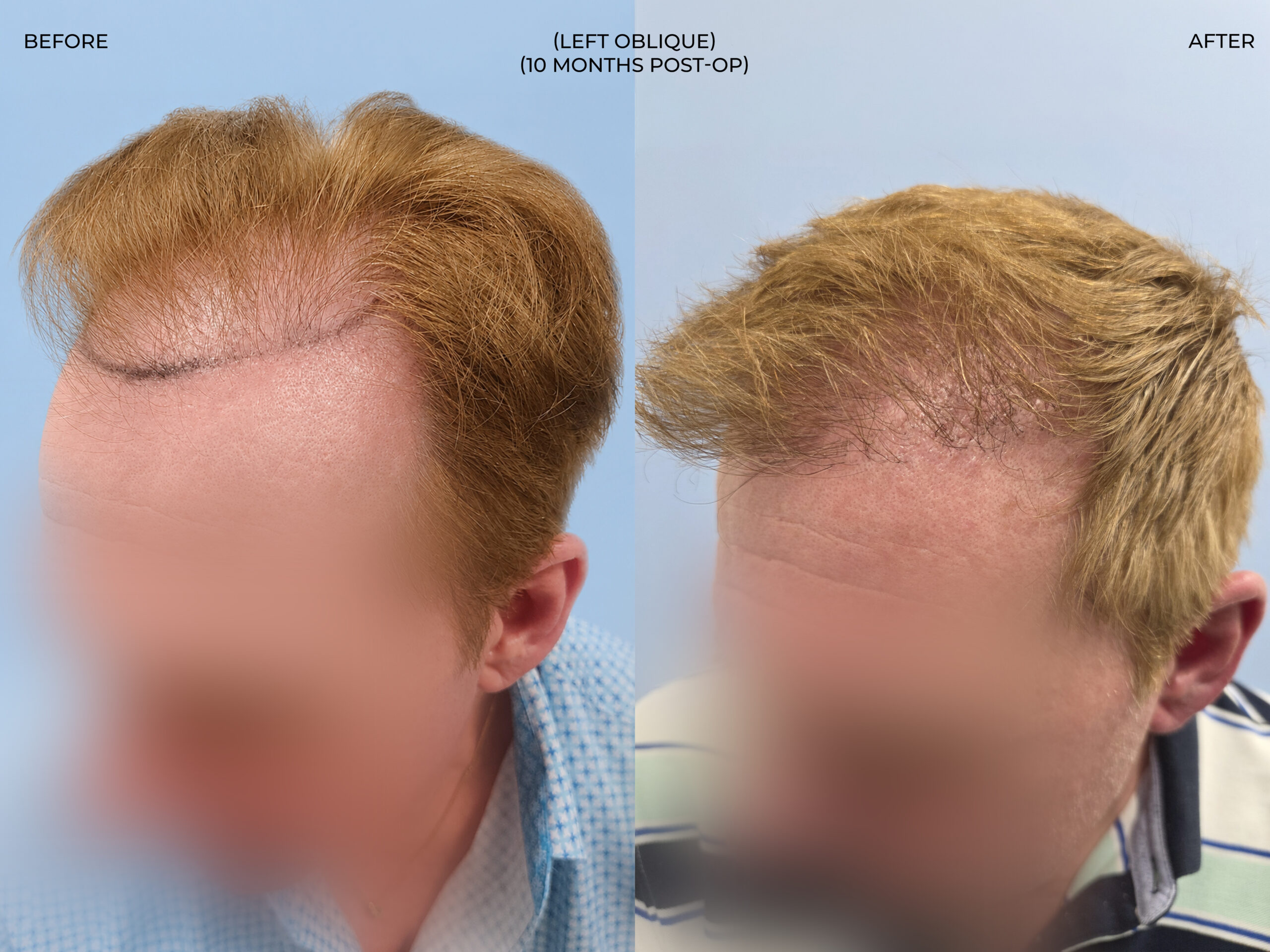 Left oblique view before and after FUT (strip), 3,300 grafts, 57 year old man