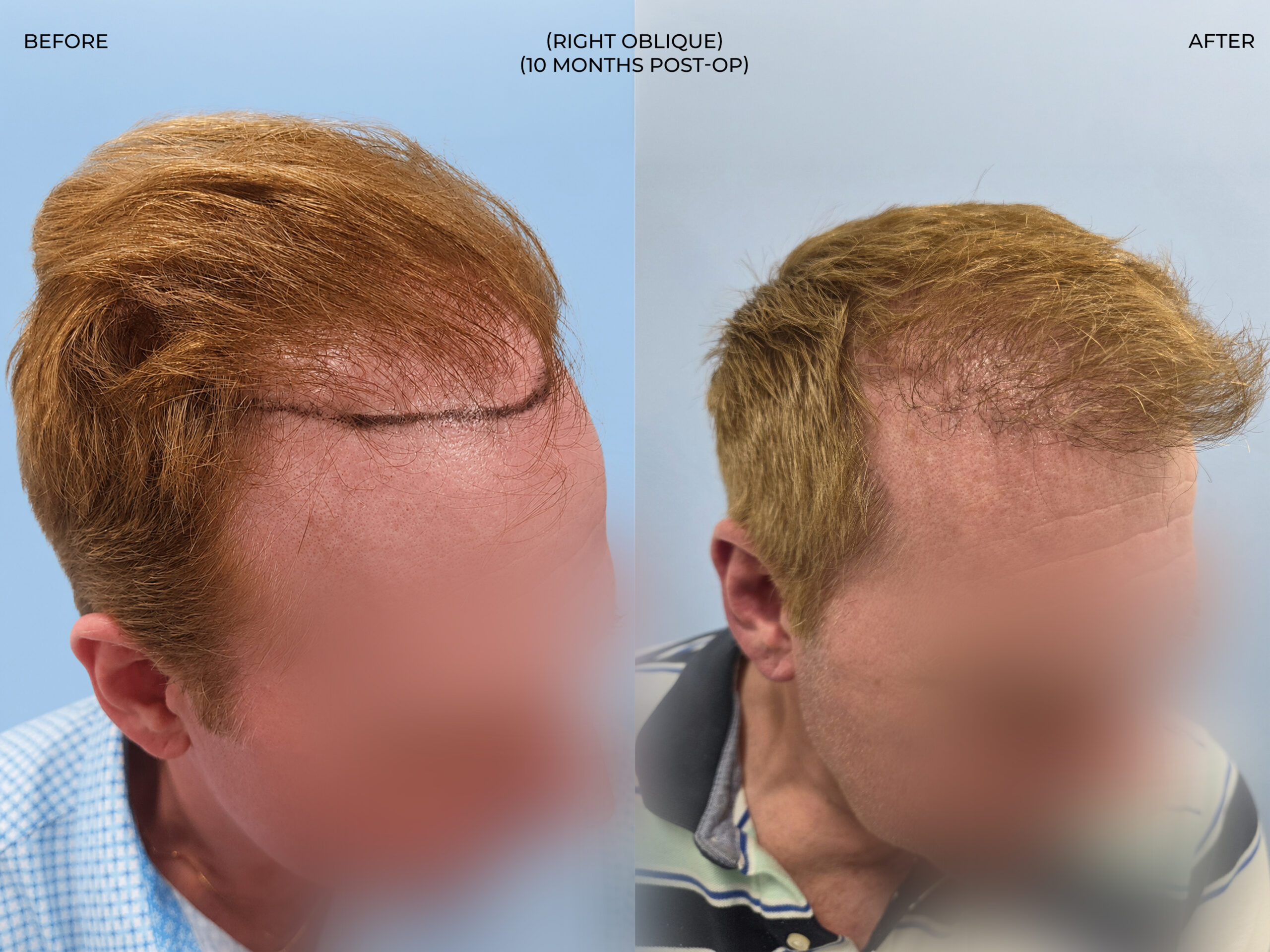 Right oblique view before and after FUT (strip), 3,300 grafts, 57 year old man