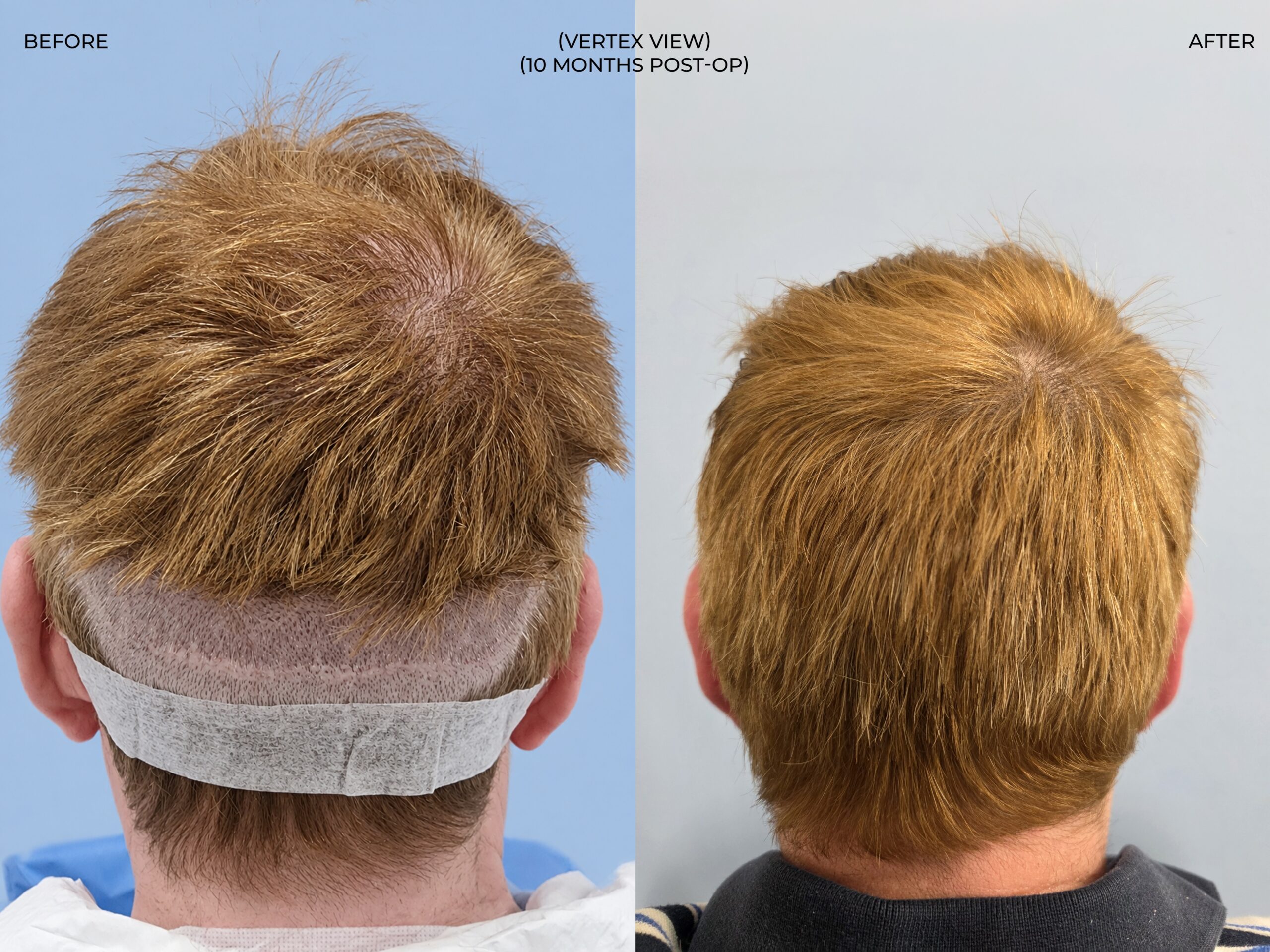 Vertex (crown) view before and after FUT (strip), 3,300 grafts, 57 year old man