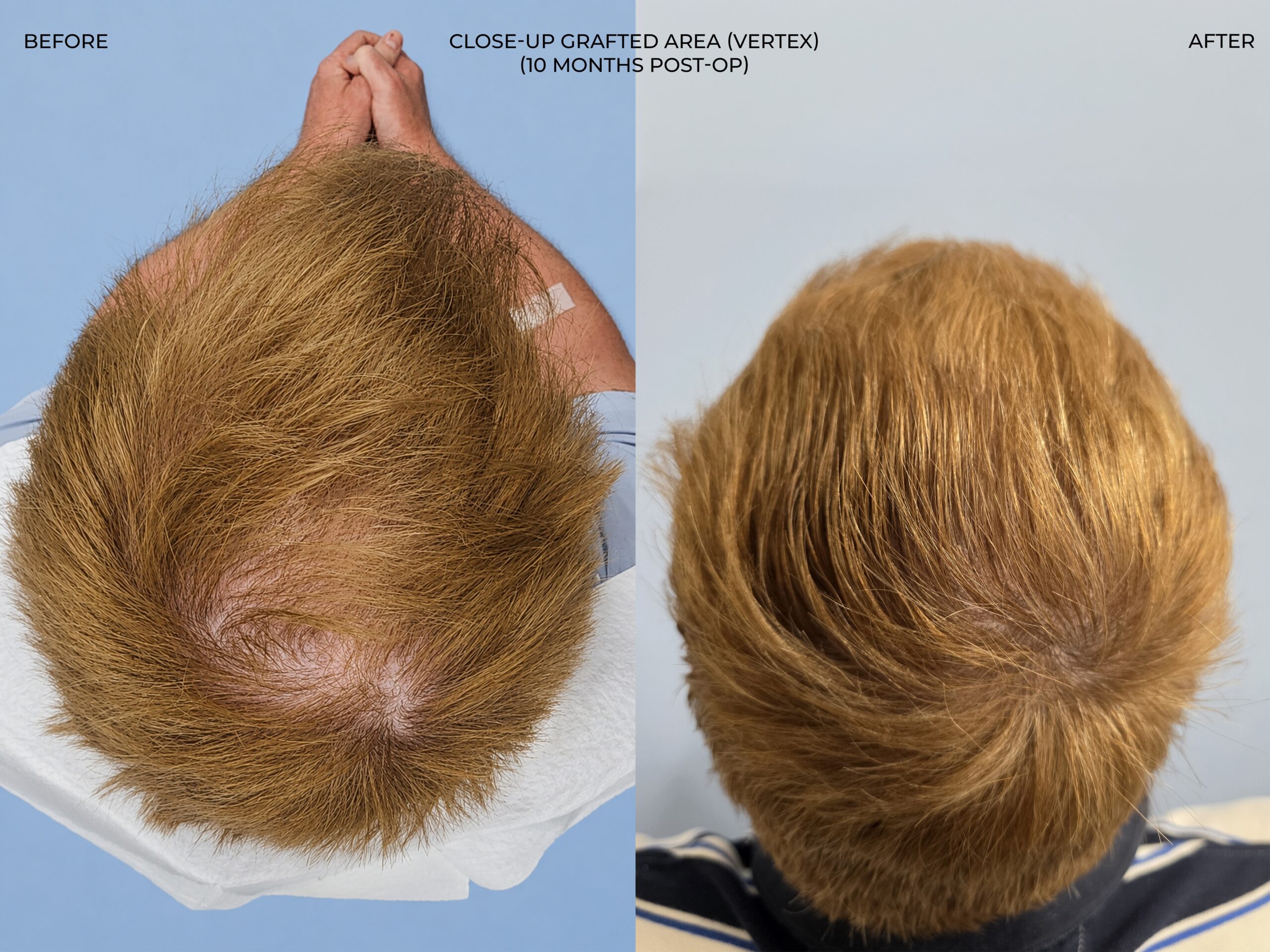 Donor area view before and after FUT (strip), 3,300 grafts, 57 year old man