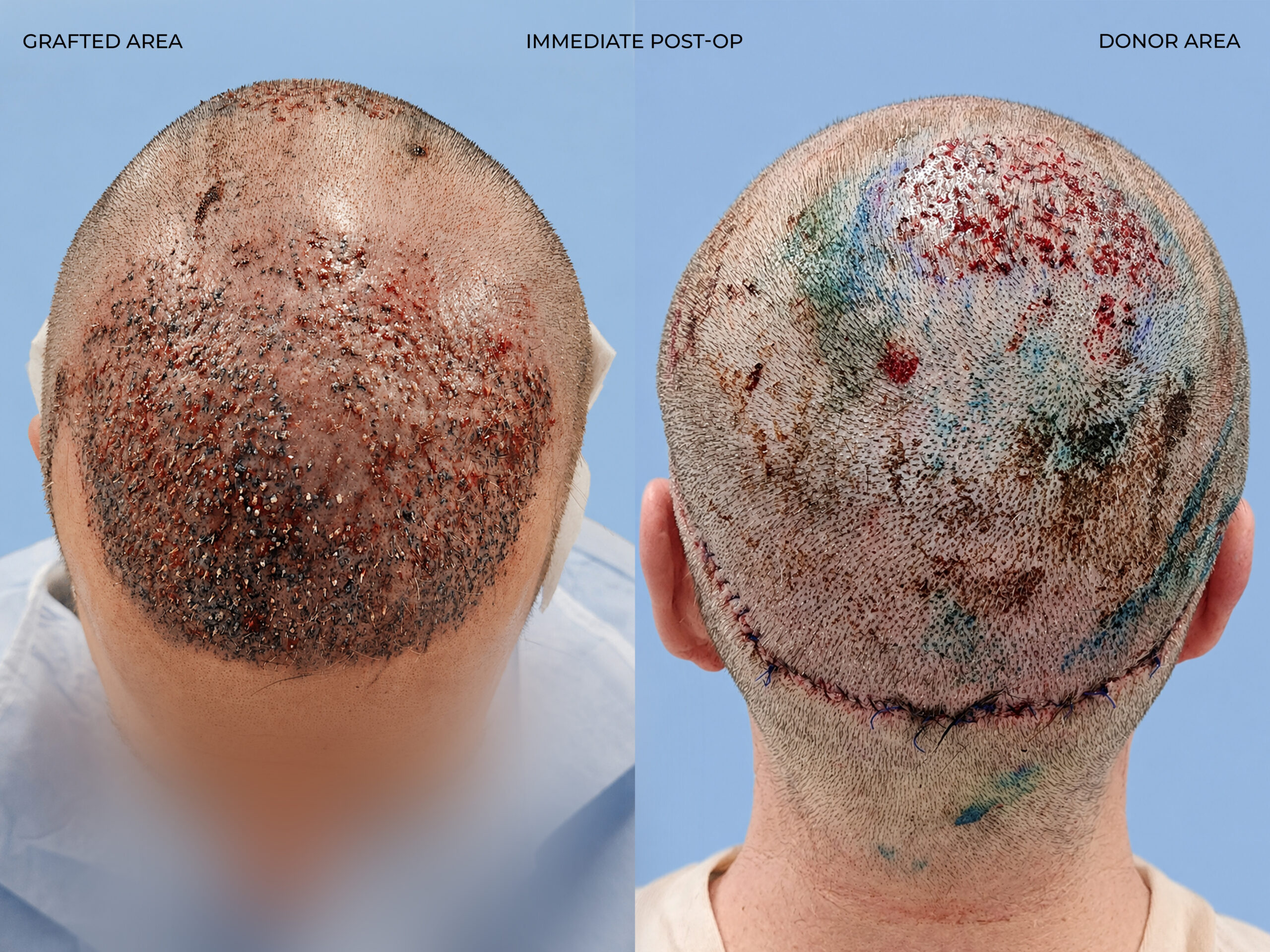 Hairline close-up view before and after FUT (strip), 3,300 grafts, 57 year old man