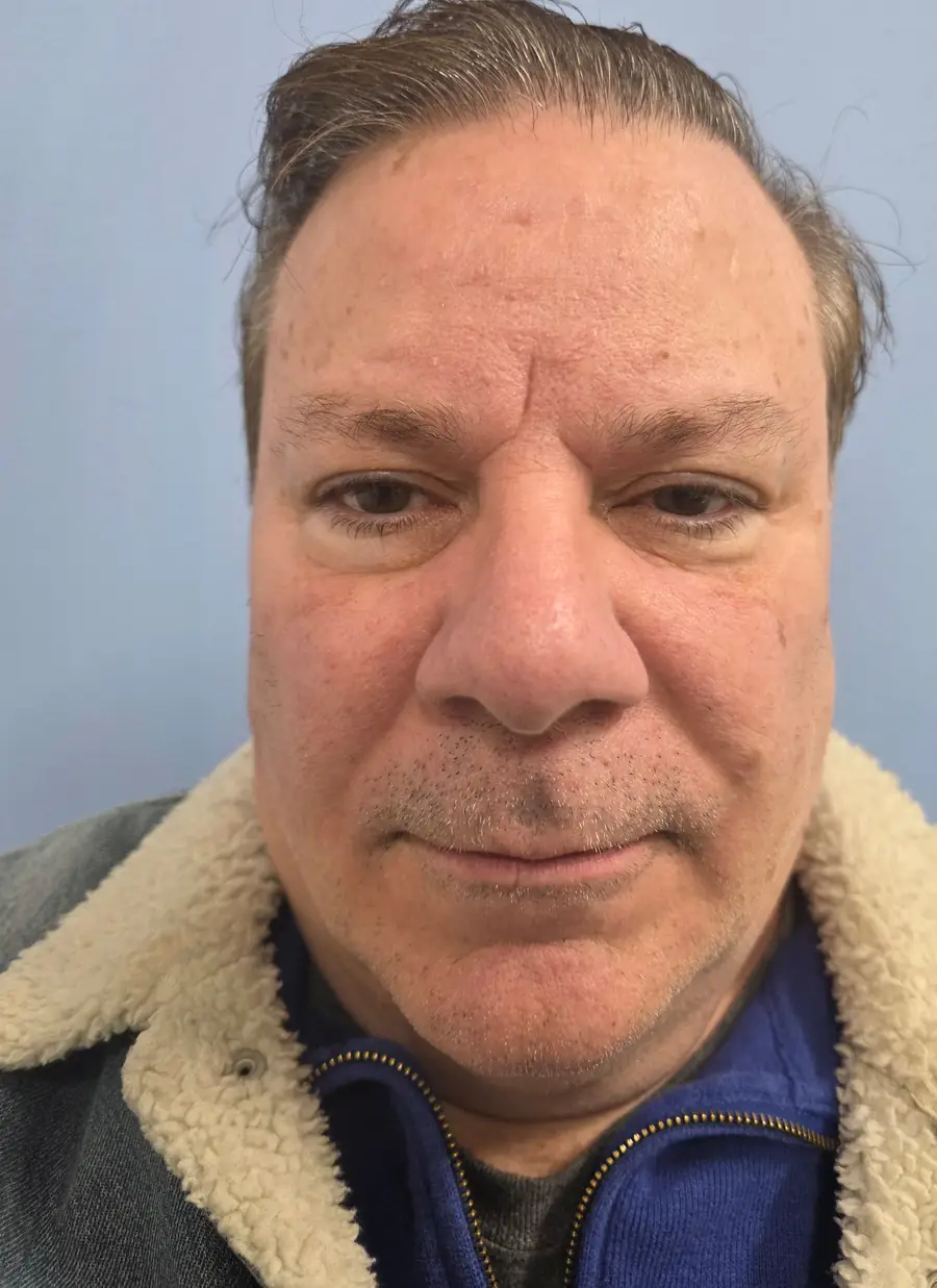 FUE (NeoGraft) result