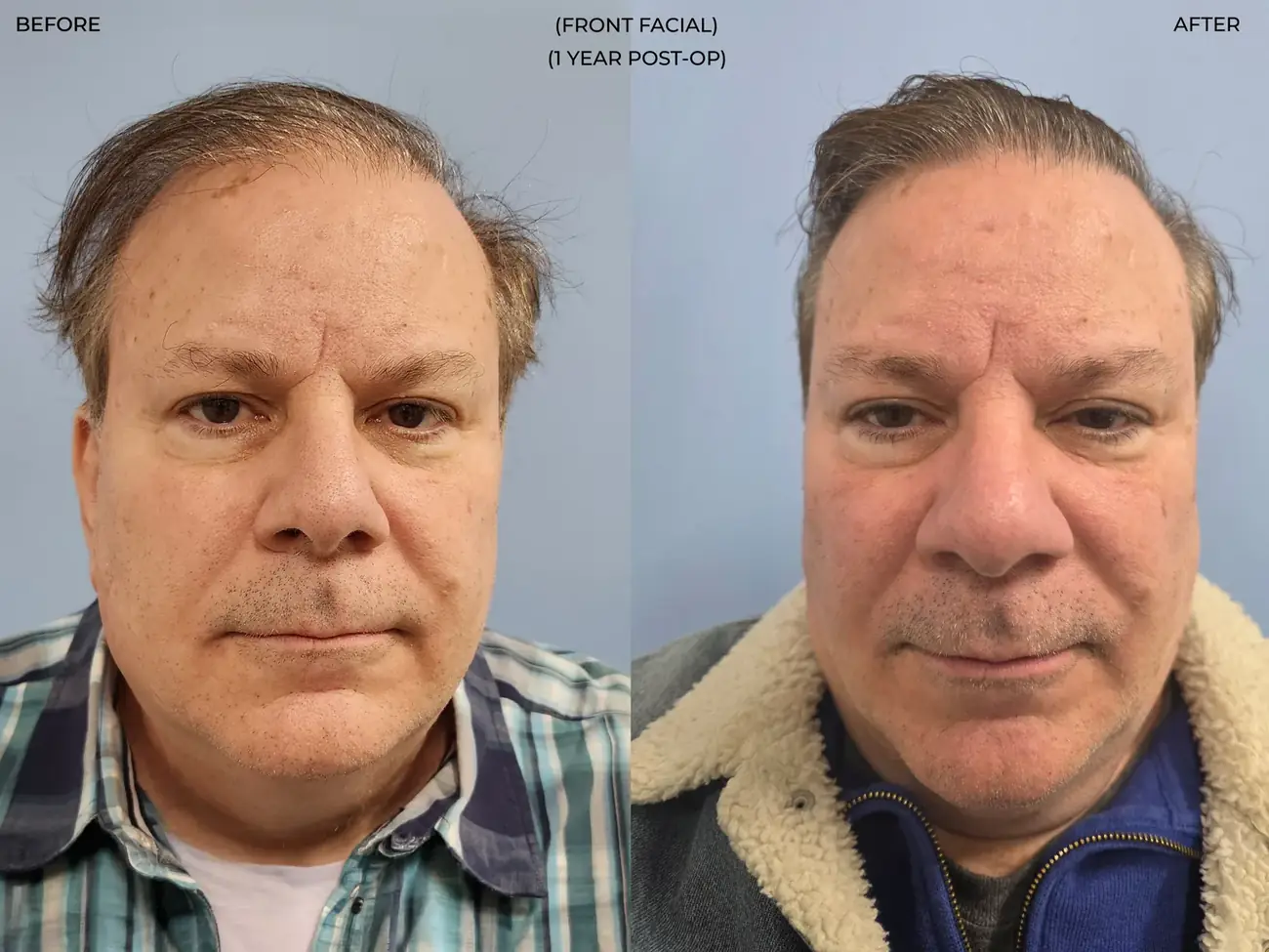 Front facial view before and after FUE (NeoGraft), 2,458 grafts, 62 year old man