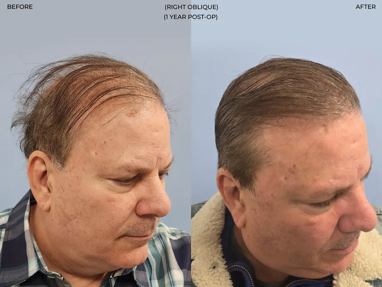 Right oblique view before and after FUE (NeoGraft), 2,458 grafts, 62 year old man