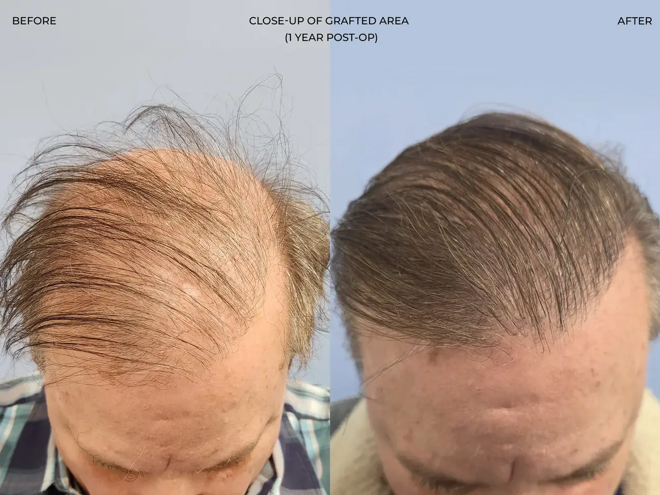 Top-down view before and after FUE (NeoGraft), 2,458 grafts, 62 year old man