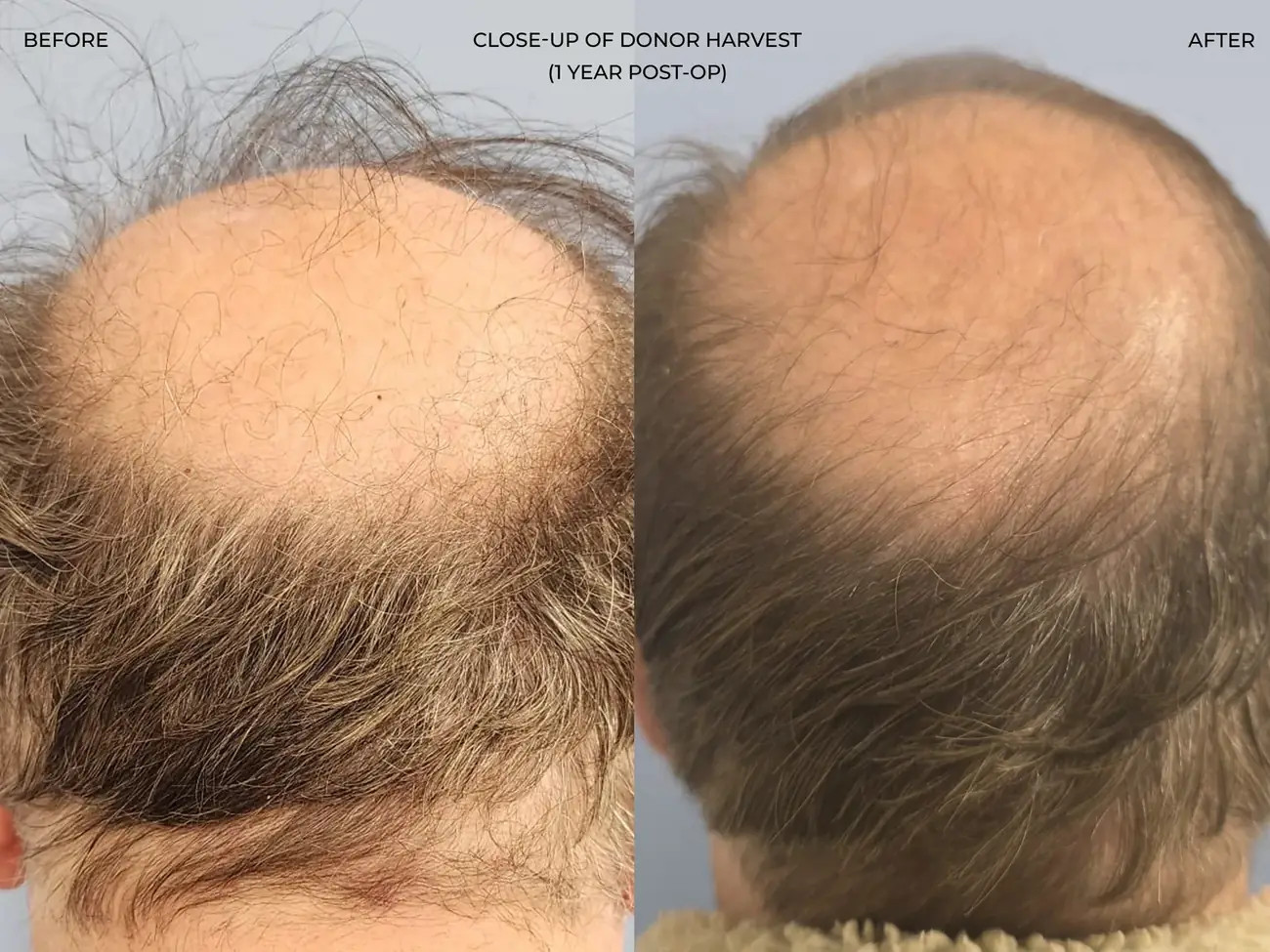 Donor area view before and after FUE (NeoGraft), 2,458 grafts, 62 year old man