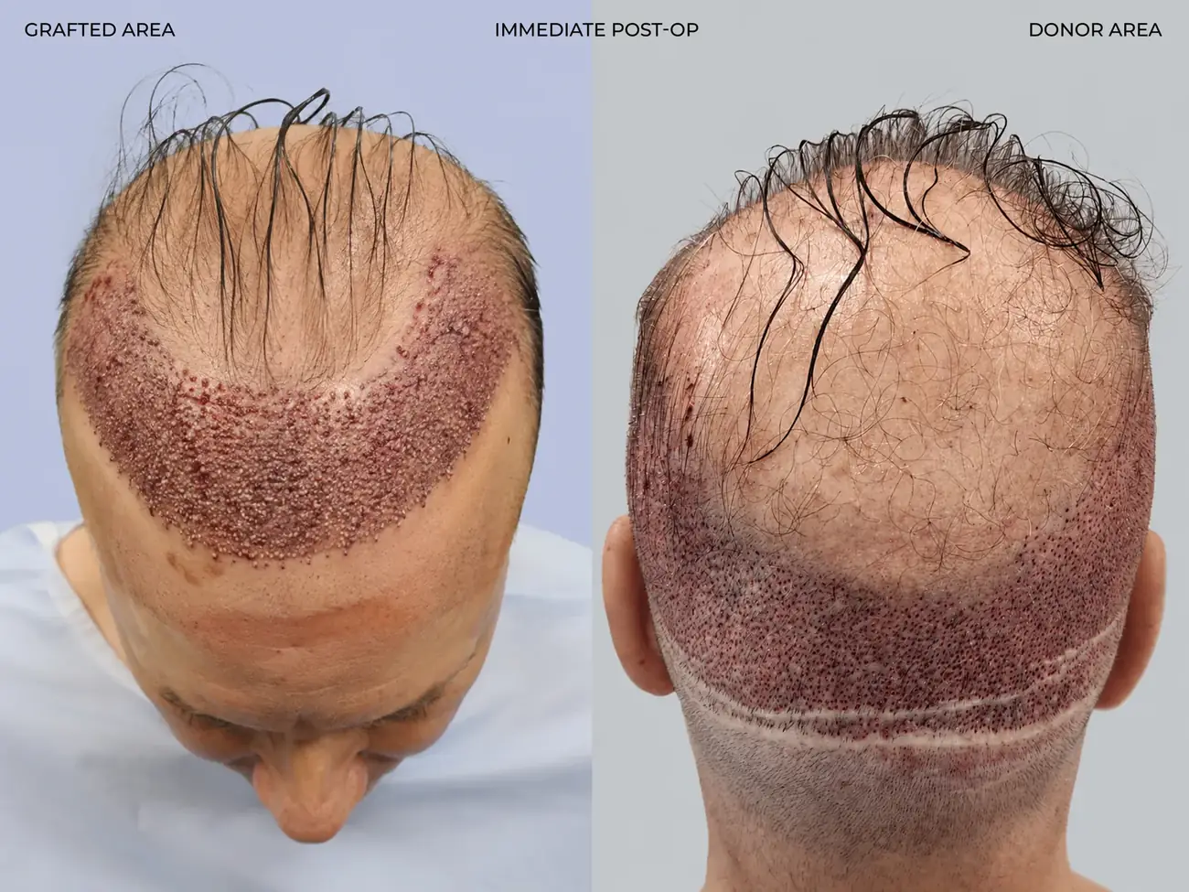 Hairline close-up view before and after FUE (NeoGraft), 2,458 grafts, 62 year old man