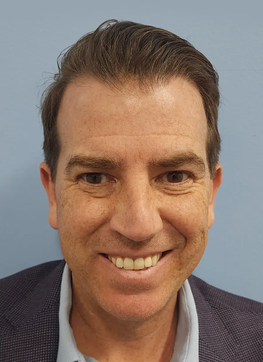 After FUE — ARTAS iXi robotic, 1,414 grafts, one year post-op