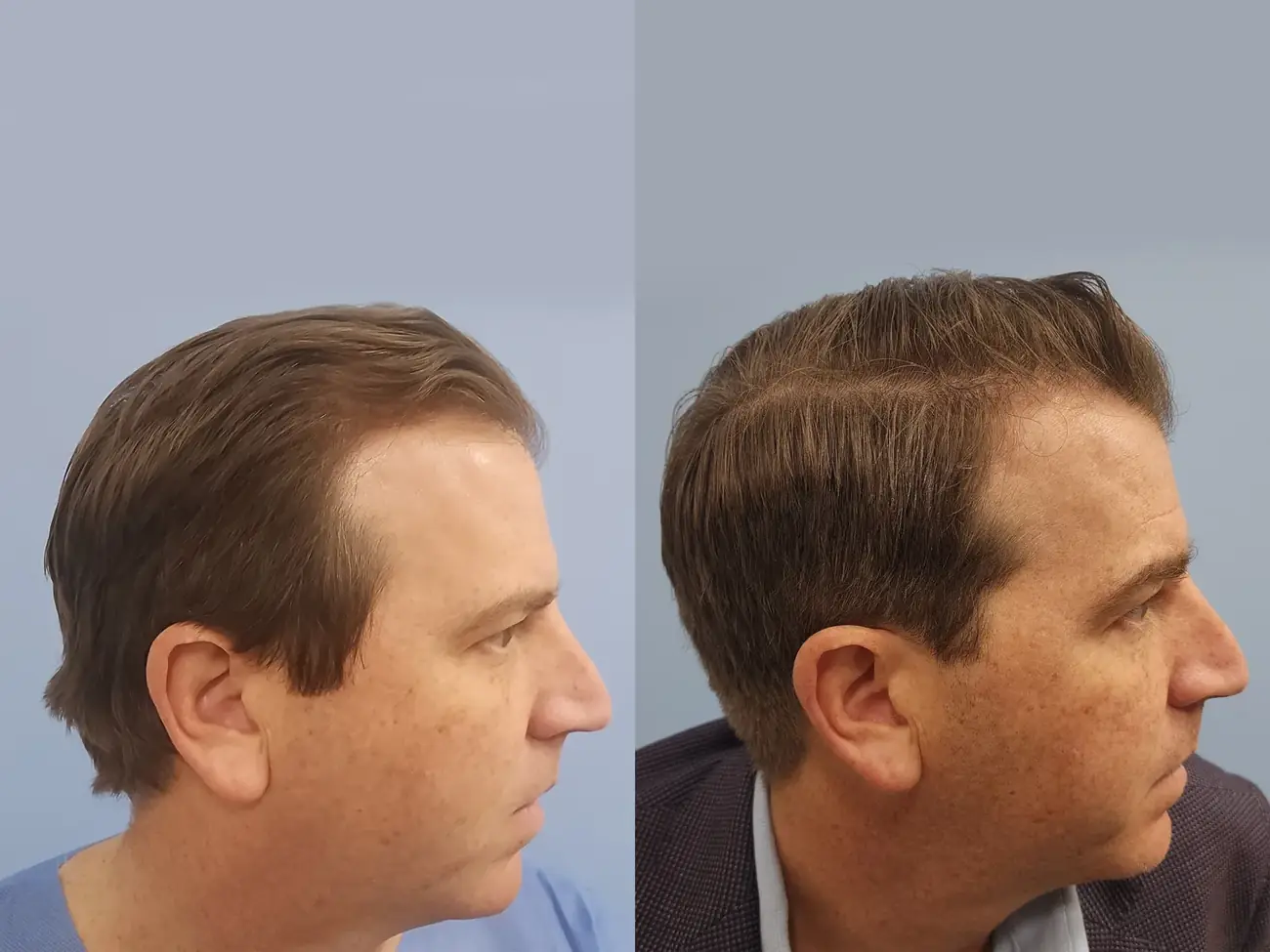 Right oblique view before and after FUE — ARTAS iXi robotic, 1,414 grafts, 46 year old man
