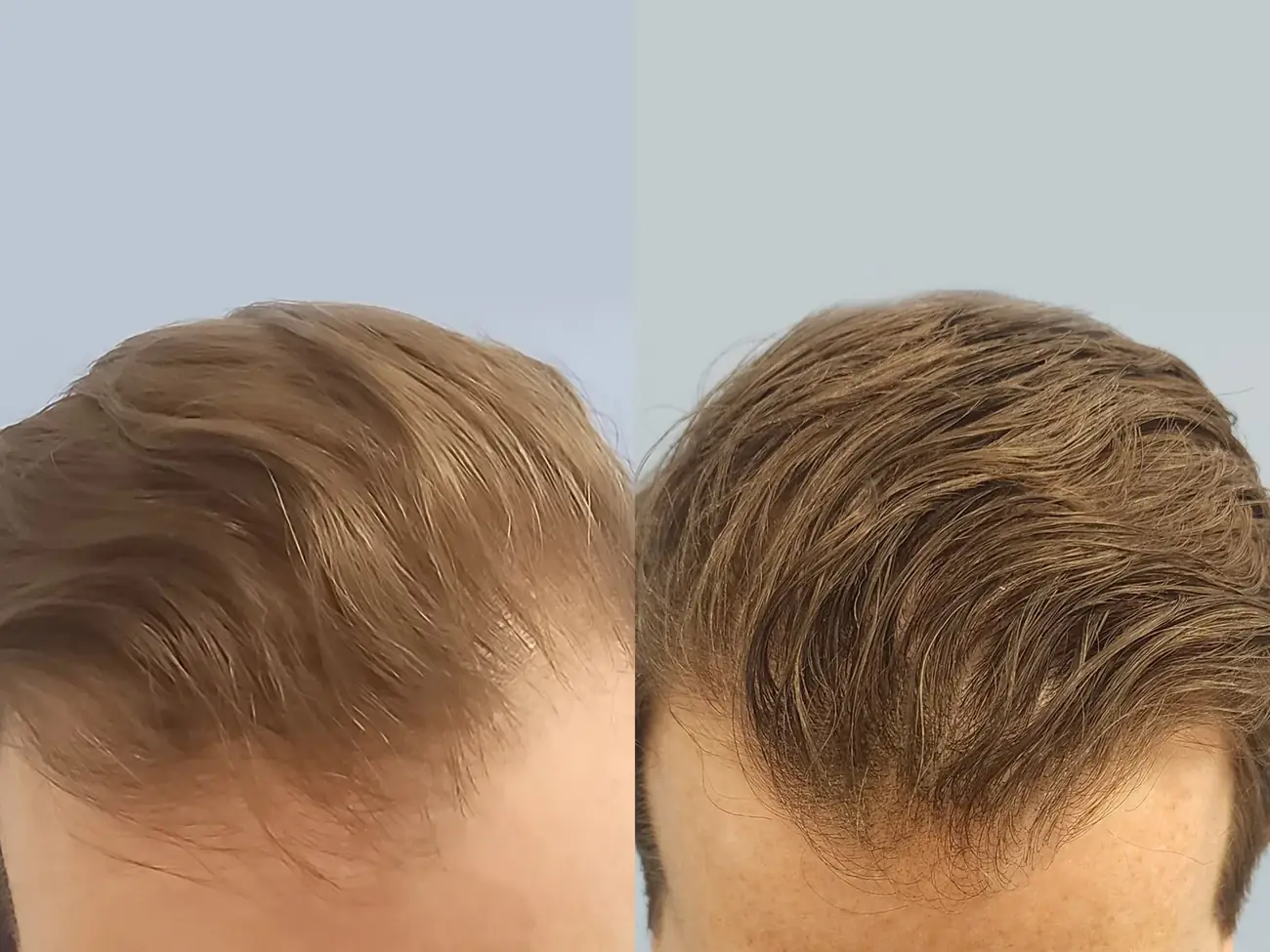Top-down view before and after FUE — ARTAS iXi robotic, 1,414 grafts, 46 year old man
