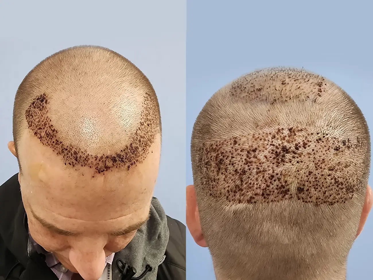 Hairline close-up view before and after FUE — ARTAS iXi robotic, 1,414 grafts, 46 year old man