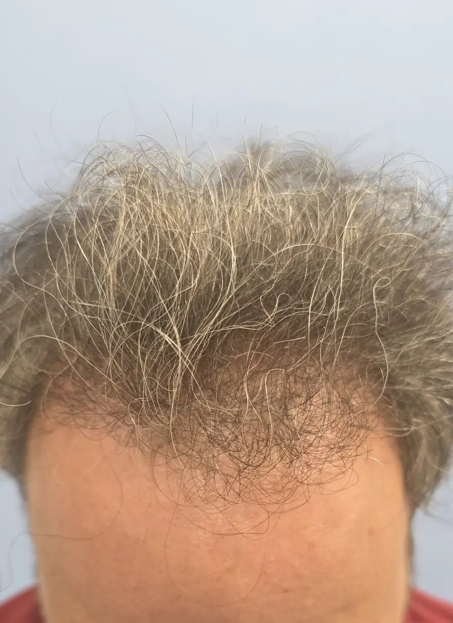 After hair transplant — 3,381 grafts · 53 y/o man