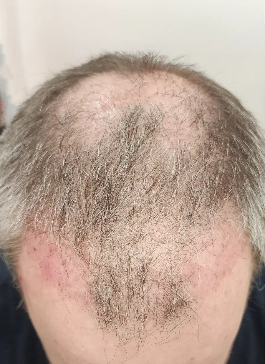 Before hair transplant — 3,381 grafts · 53 y/o man