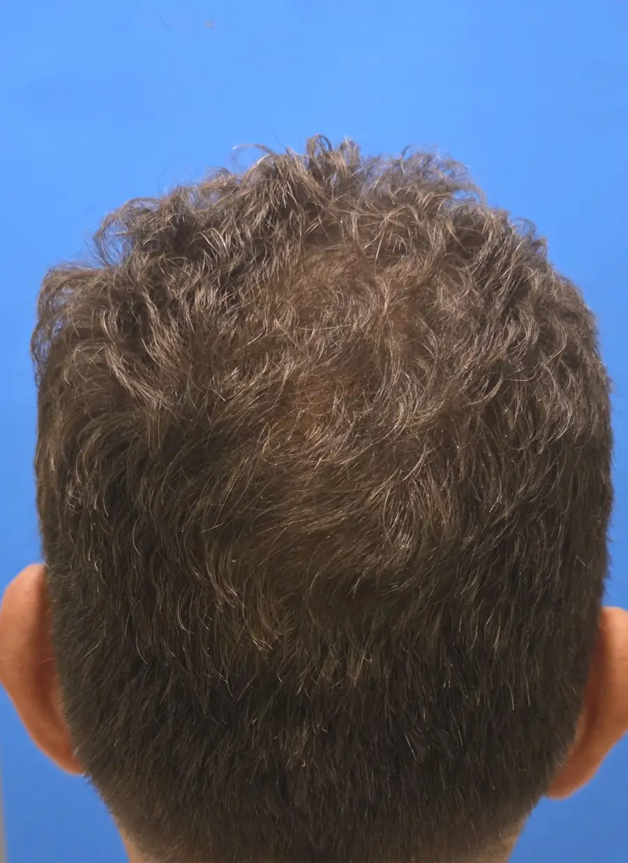 FUE — ARTAS iXi robot + NeoGraft result