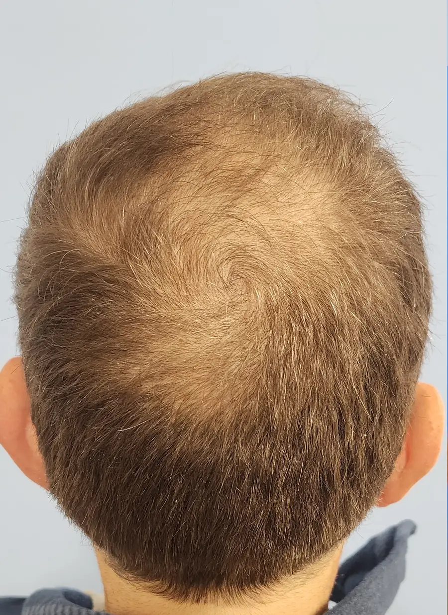 Before FUE — ARTAS iXi robot + NeoGraft, 59 year old man