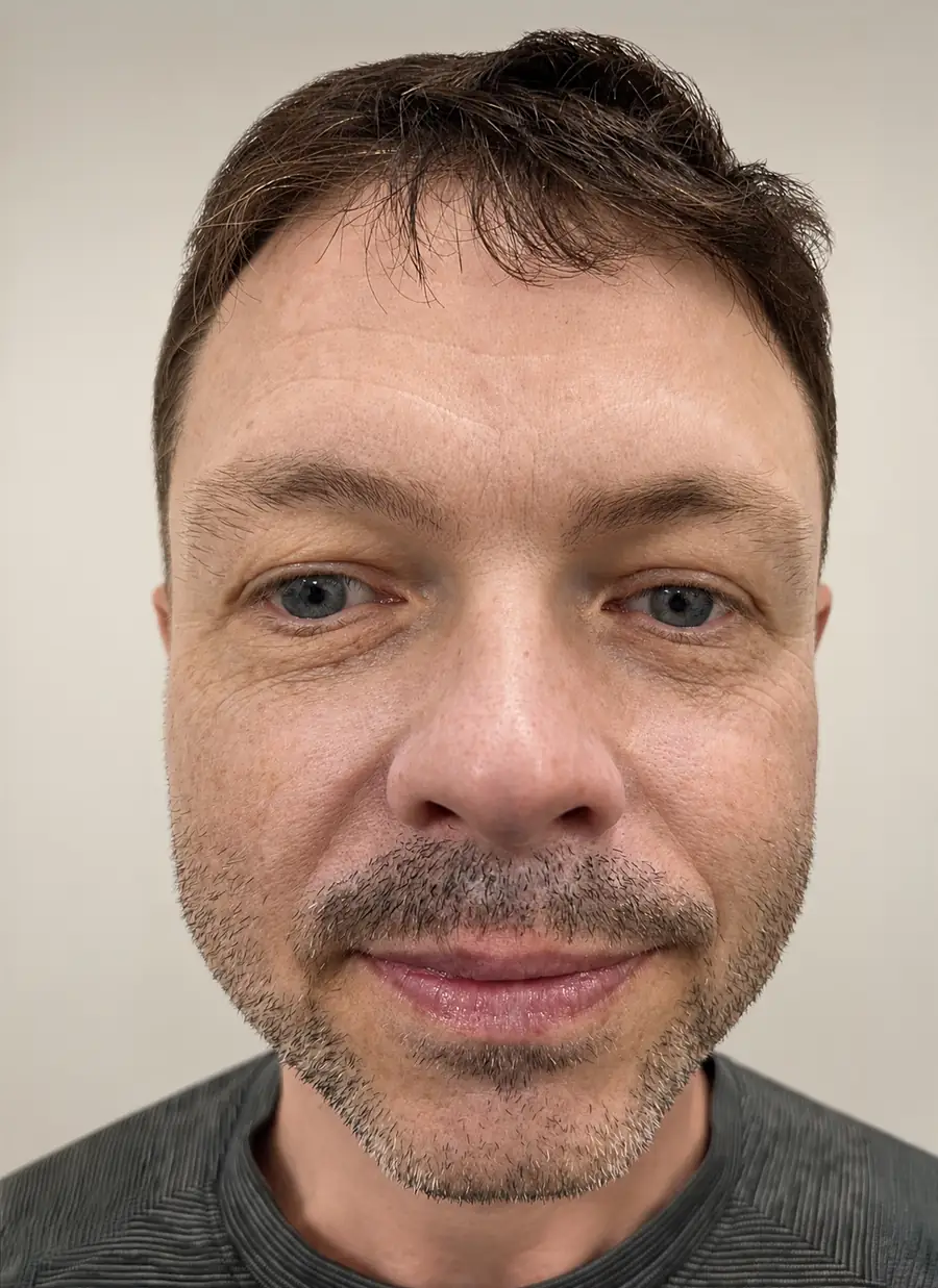 After hair transplant — 275 grafts · 44 y/o man