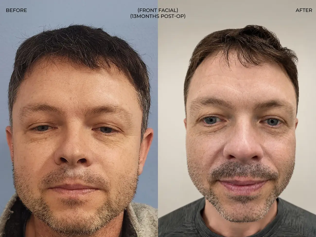 Front facial view before and after FUE — lip trauma repair, 275 grafts, 44 year old man